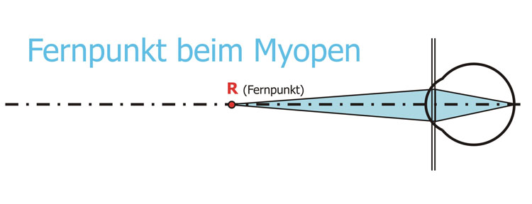 Fernpunkt des Auges bei Myopie