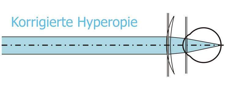 Korrektur der Hyperopie (Übersichtigkeit) mit Sammellinsen (Linsen mit Pluswirkung).