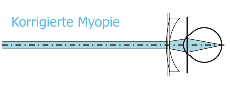 Korrektur der Myopie mit Zertreuungslinsen, also mit Minuslinsen.