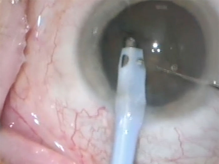 Phakoemulsifikation