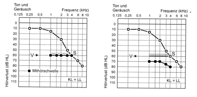 Langenbecksche Geräuschaudiometrie
