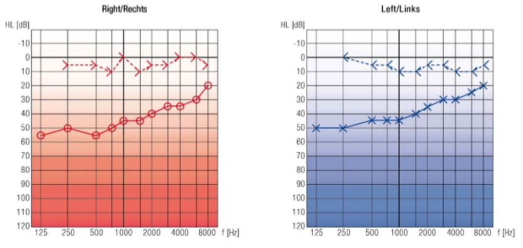 Audiogramm Versteifungstyp