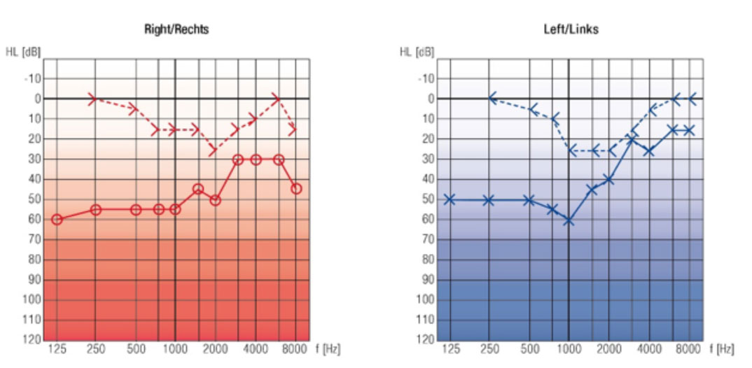 Audiogramm Carhart-Senke bei Versteifungstyp