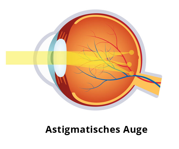 Astigmatismus