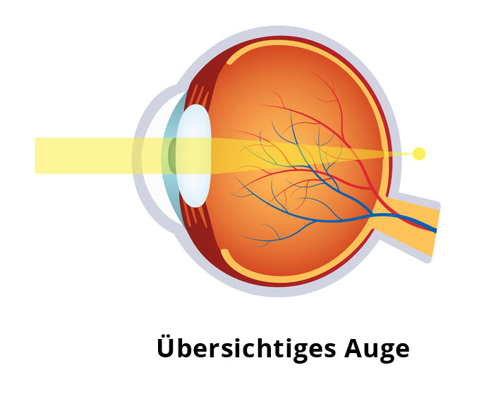 Übersichtigkeit - Hyperopie