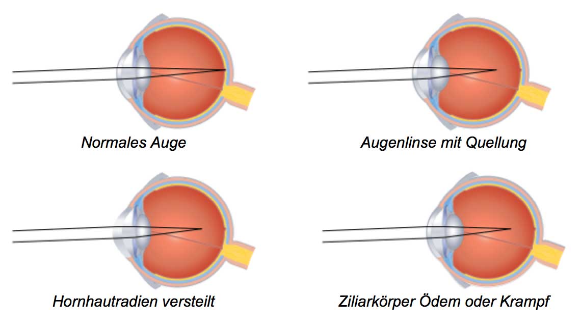 Auge Refraktionsänderung