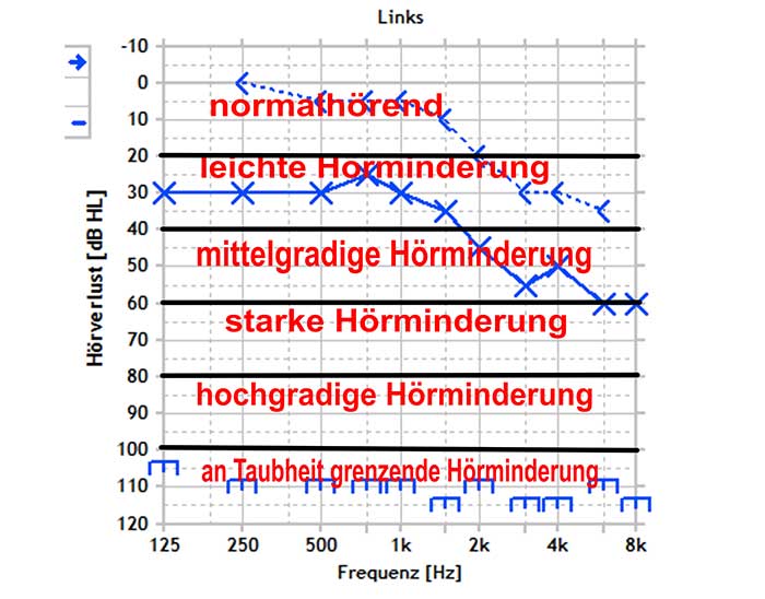 Bewertung des Grades einer Schwerhörigkeit