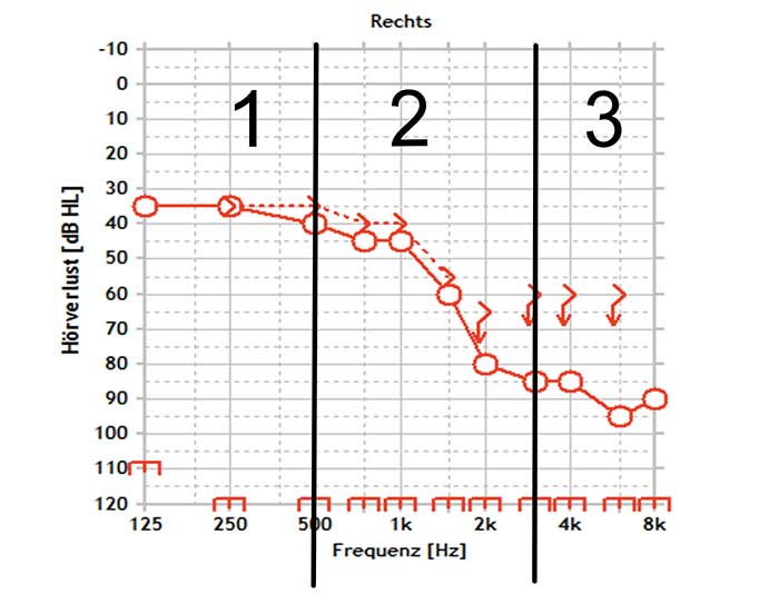 Beschreibung eines Audiogramms