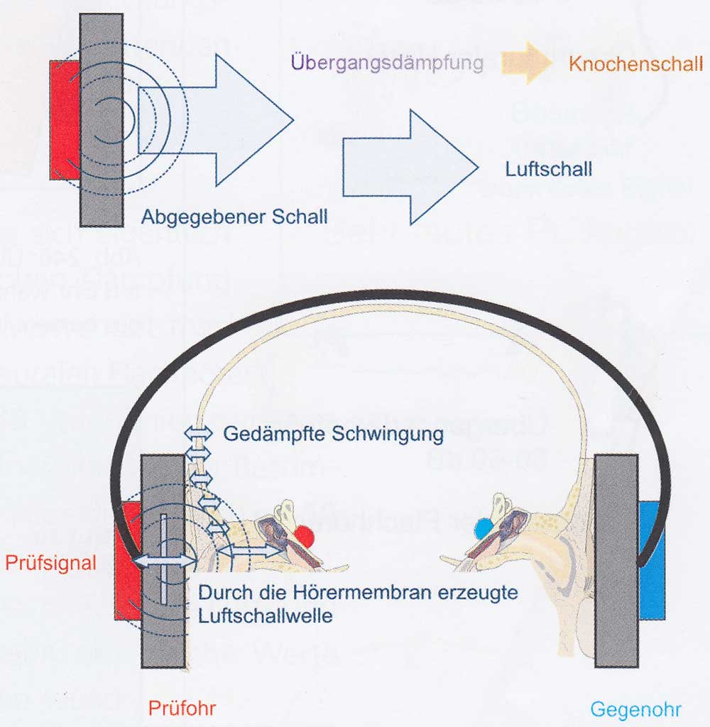 Ein Überhören ist nur möglich, wenn der Hörverlust beider Ohren unterschiedlich stark ausgeprägt ist